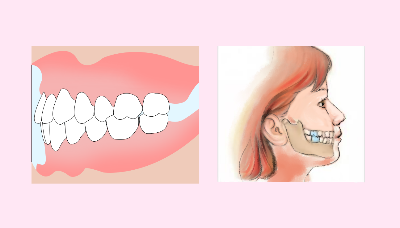 牙齒矯正 牙齒矯正