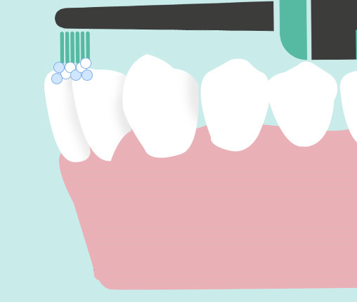 牙齒美白 牙齒美白