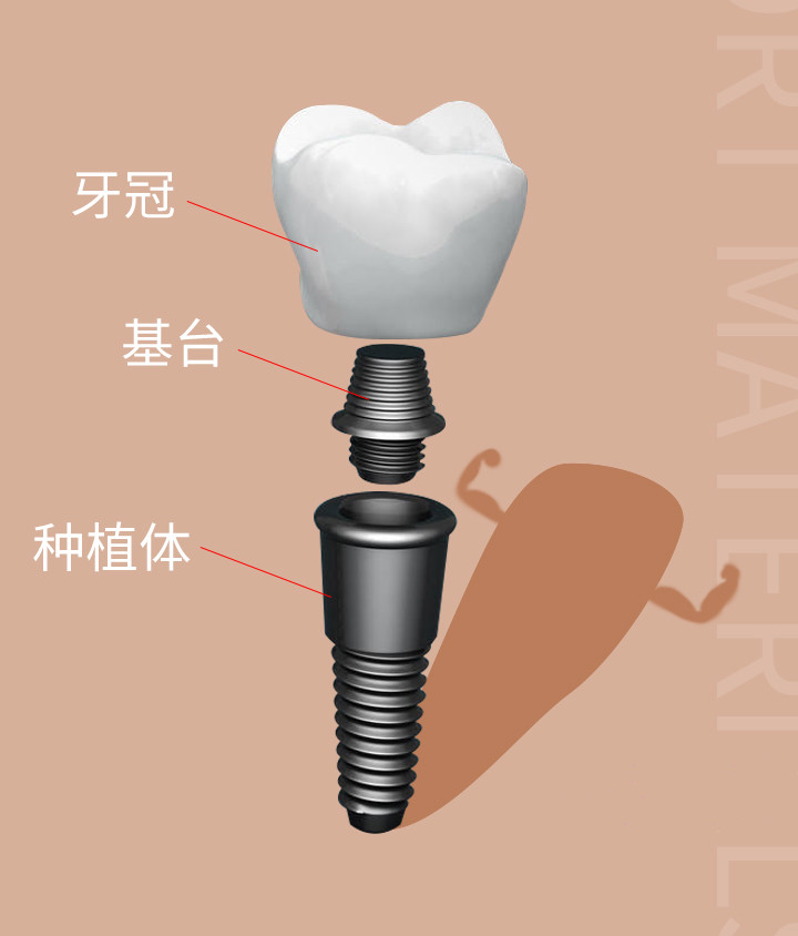 種植牙的構(gòu)造圖 種植牙的構(gòu)造圖