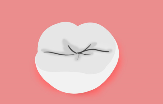 牙齒窩溝 牙齒窩溝