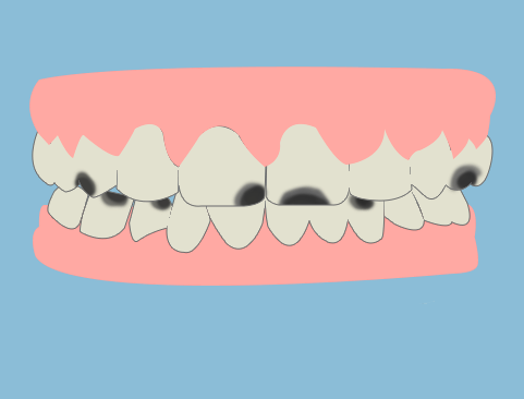 蛀牙黑牙 蛀牙黑牙