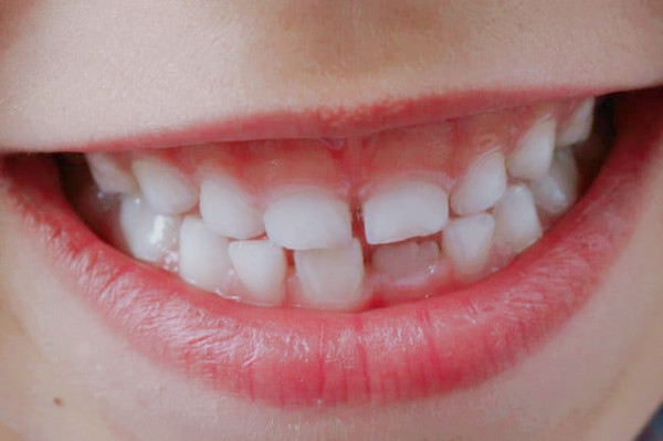 牙齒發(fā)育不全 牙齒發(fā)育不全