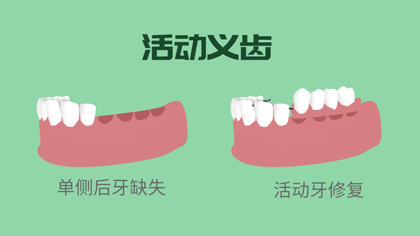 活動義齒 活動義齒