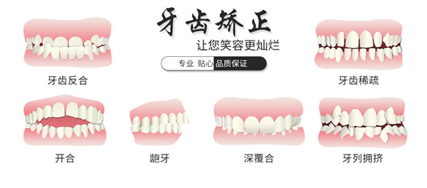 牙齒矯正類型 牙齒矯正類型